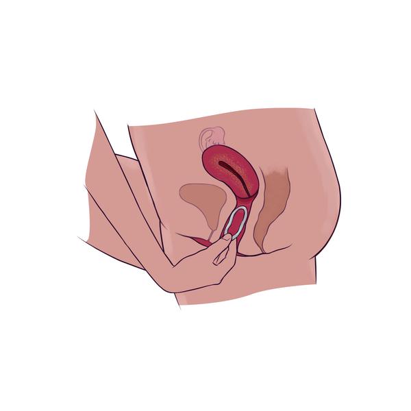 Vagina fotos Vaginal Cancer