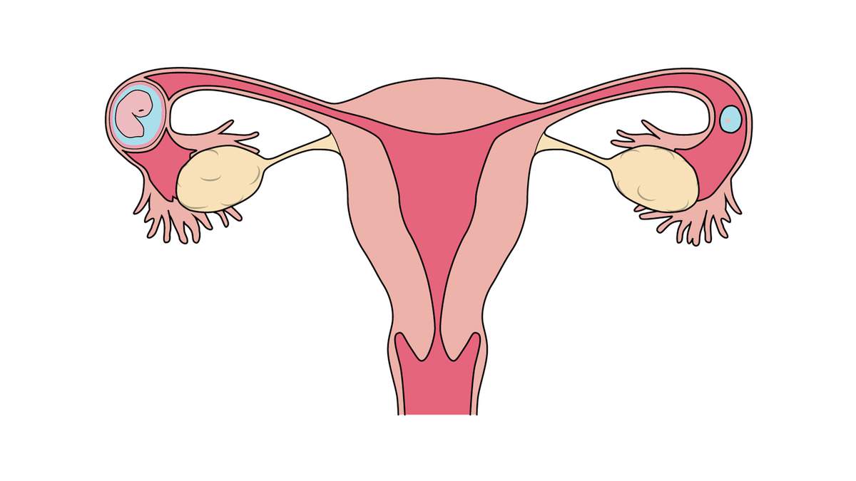 What Is Ectopic Pregnancy? | Definition and Treatment