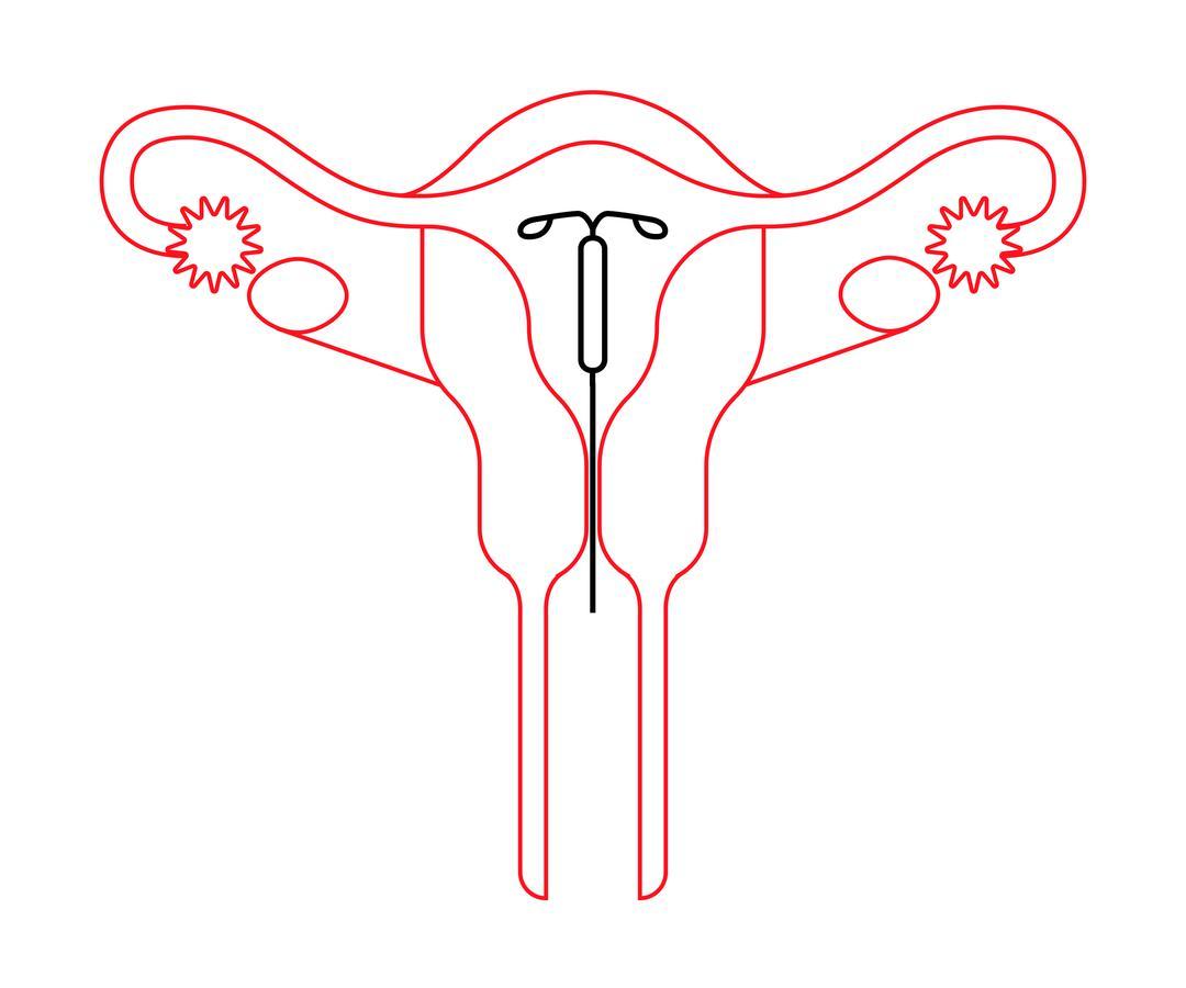 After iud insertion side effects What To
